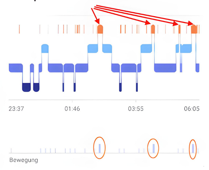 Schlafprotokoll mit vier Aufwachphasen (orange) während des REM-Schlafs (blau). Am unteren Rand: Bewegungsdaten zeigen das Wenden im Bett.